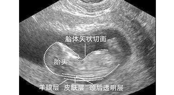 东洲区代怀生儿子_东洲区代怀妈妈叫我_试管怀孕后，NT检查是什么？有什么作